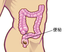 福州医博医院治便秘